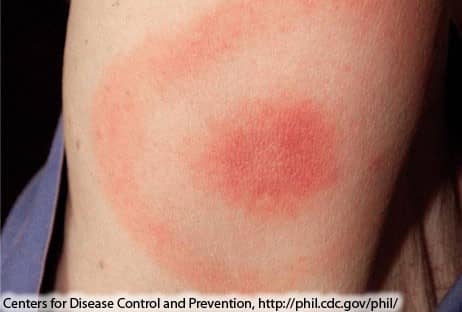 Lyme Disease Rash 1A