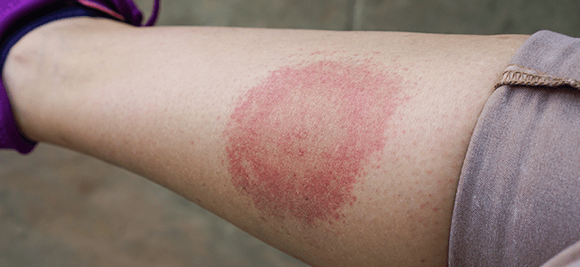 Lyme Disease Rash